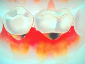 Exposição do colo do dente (raiz)